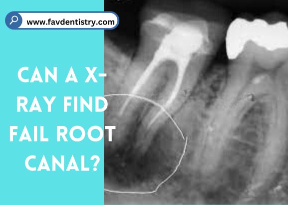 Can A X-Ray Find Fail Root Canal?