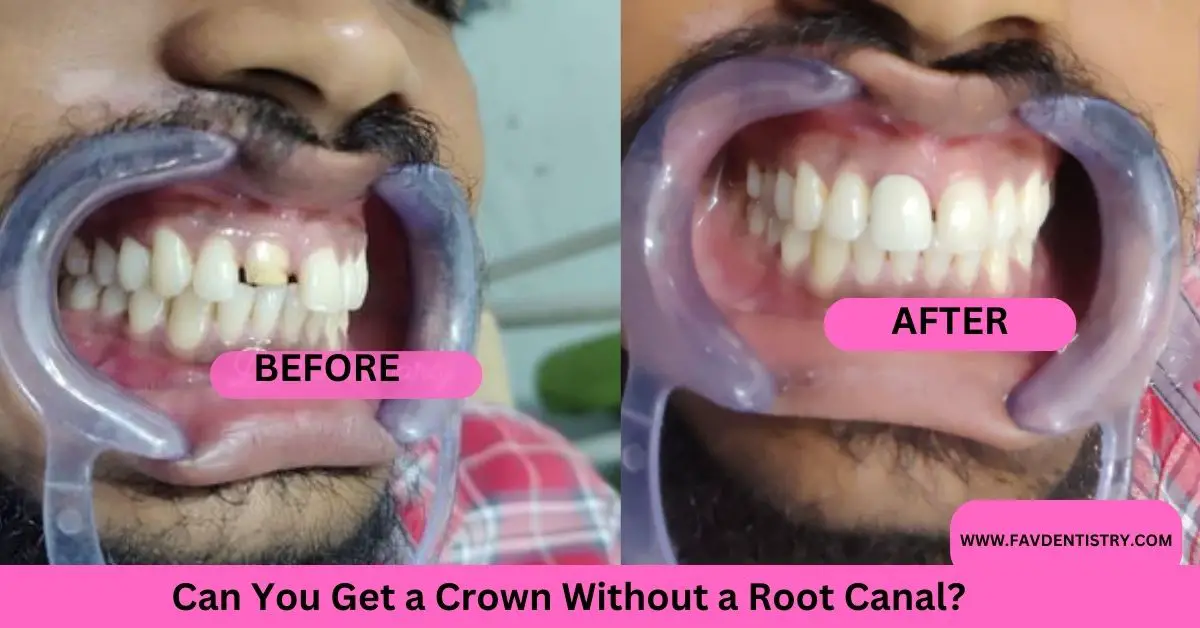 Can You Get a Crown Without a Root Canal?