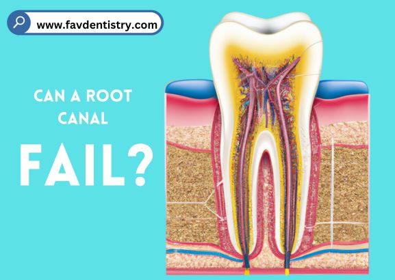 Can a Root Canal Fail?