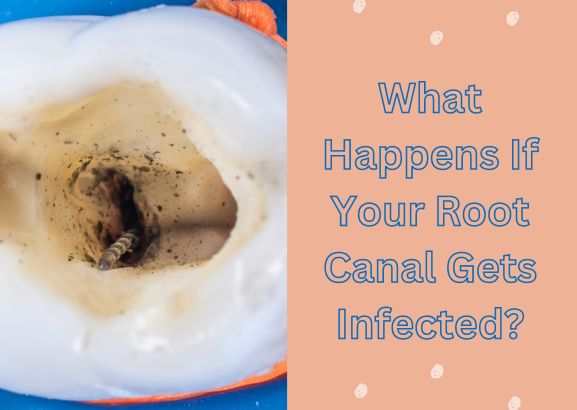 What Happens If Your Root Canal Gets Infected?