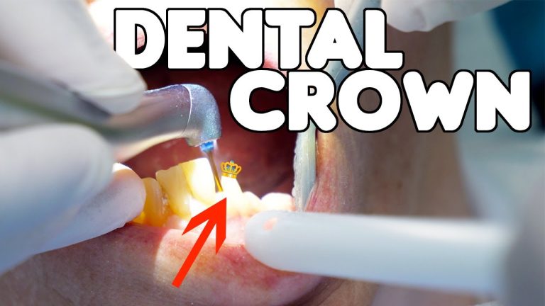 Dental Crown Procedure?