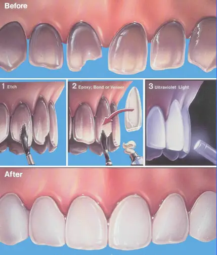 How are Dental Veneers Applied?