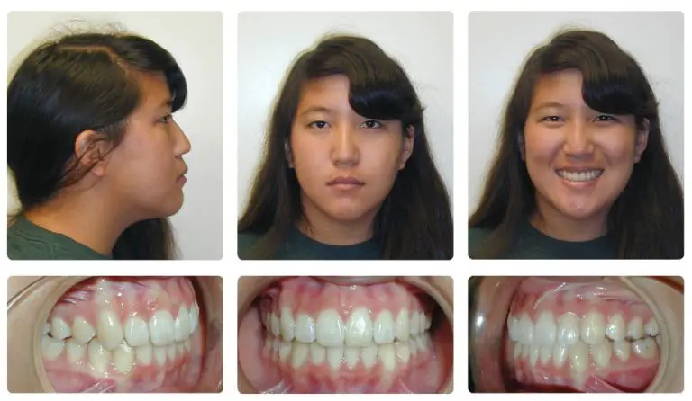 Braces before And After Overbite?