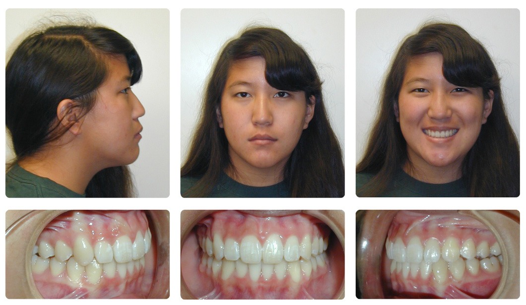 Braces before And After Overbite? favourite dentistry