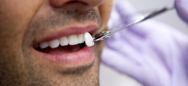 How Much Do Dental Veneers Cost Per Tooth?
