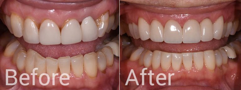 Dental Crowns before And After?