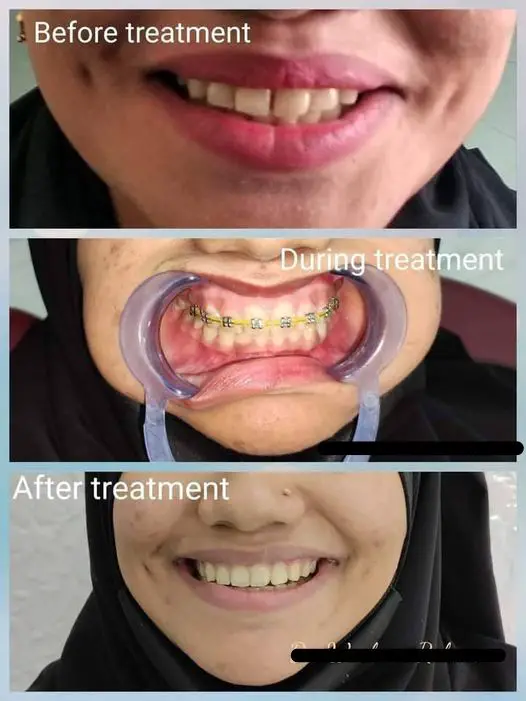 Braces before And After?