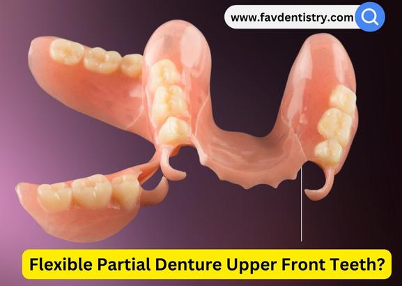 Flexible Partial Denture Upper Front Teeth?