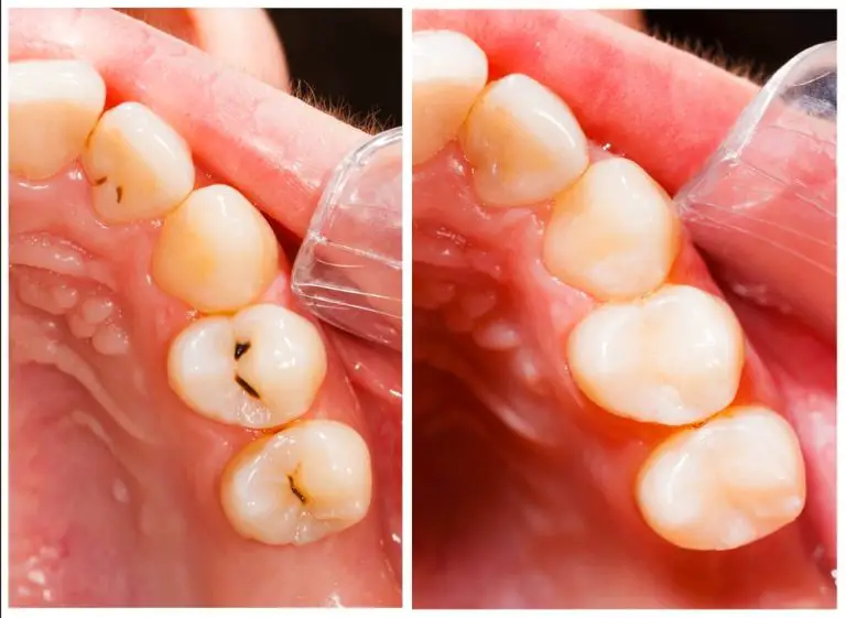 What Does a Tooth Filling Look Like?