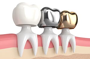 Low-Cost Dental Crowns?