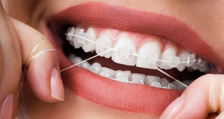 How to Floss With Braces?