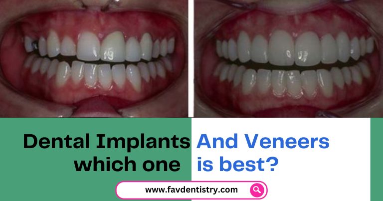 Dental Implants And Veneers which one is best?