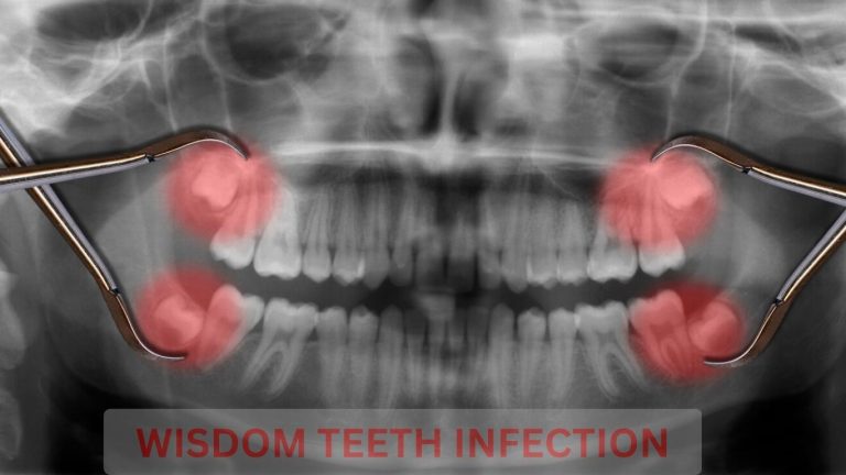 Signs of Infection After Wisdom Tooth Removal?