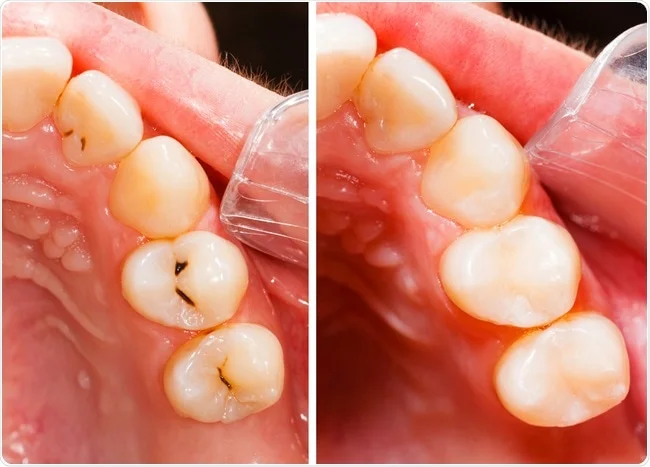 tooth filling