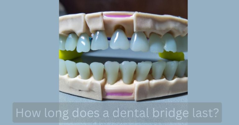 How long does a dental bridge last?