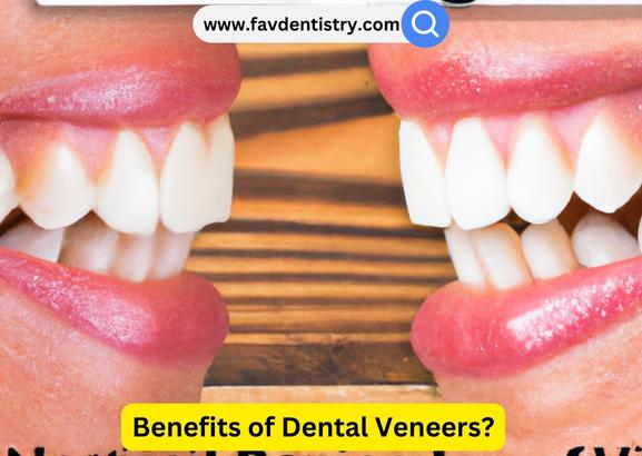 Benefits of Dental Veneers?