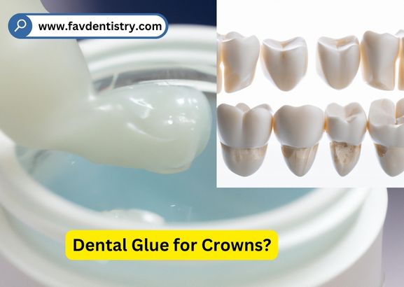 Dental Glue for Crowns?: Temporary and Permanent Options