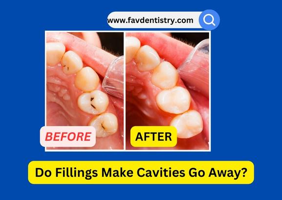 Do Fillings Make Cavities Go Away?