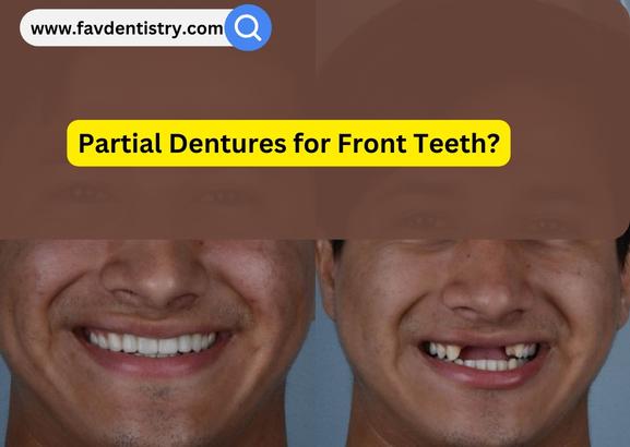 Partial Dentures for Front Teeth?