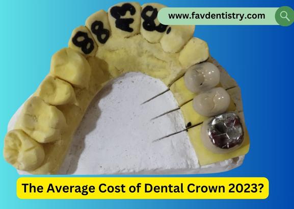 The Average Cost of Dental Crown 2023?