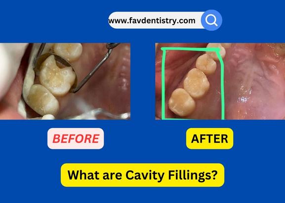 What are Cavity Fillings?