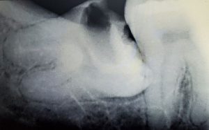 wisdom-tooth-x-ray