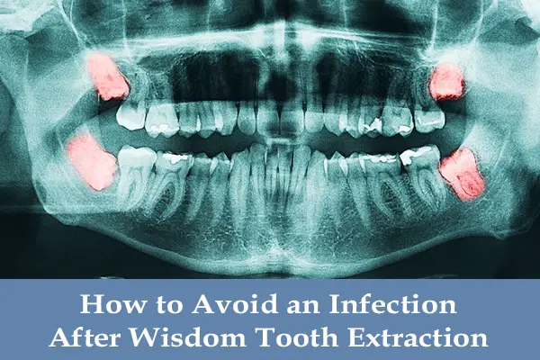 Abscess After Wisdom Tooth Extraction: Causes, Symptoms, and Treatment