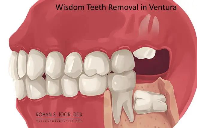 Soft Tissue Impacted Wisdom Tooth Removal: Quick and Painless Procedure