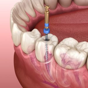 Can You Easily Extract a Root Canal Tooth: Debunking the Myths