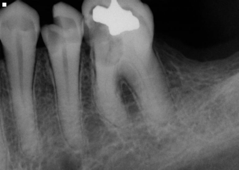 Can You Require a Root Canal Sans Cavity?