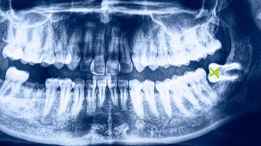 Relieve Jaw Pain After Wisdom Tooth Removal with These Power Techniques