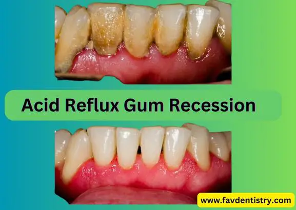 Acid Reflux Gum Recession