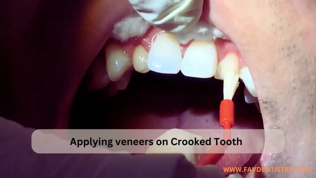 Applying veneers on Crooked Tooth