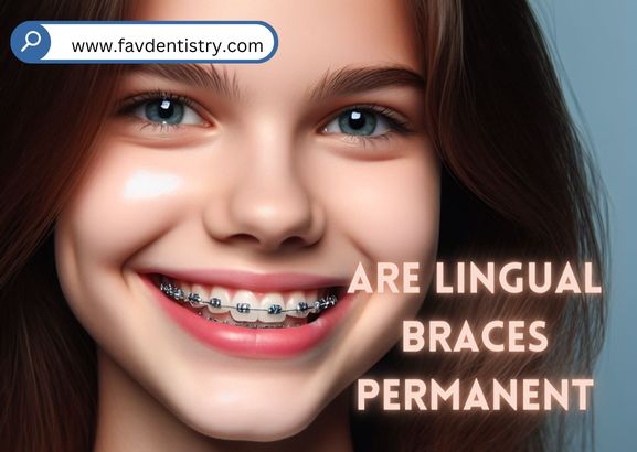 Are Lingual Braces Permanent