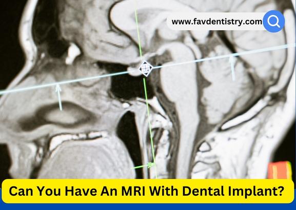 Can You Have An MRI With Dental Implant?