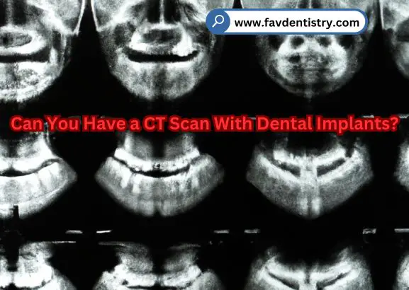 Can You Have a CT Scan With Dental Implants?