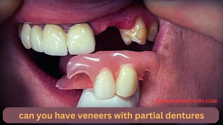 Transform Your Smile: Veneers With Partial Dentures – The Perfect Solution!
