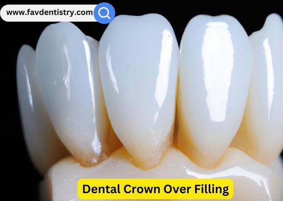 Dental Crown Over Filling