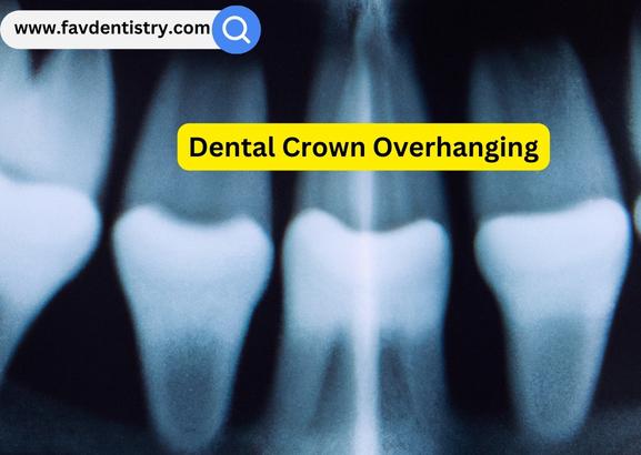 Dental Crown Overhang