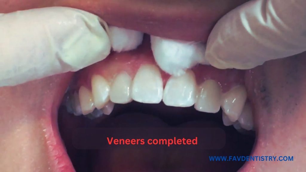 Dental Veneers for Crooked Teeth