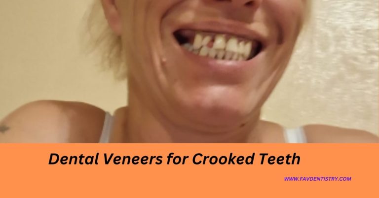 Dental Veneers for Crooked Teeth: Your Ultimate Solution for a Flawless Smile