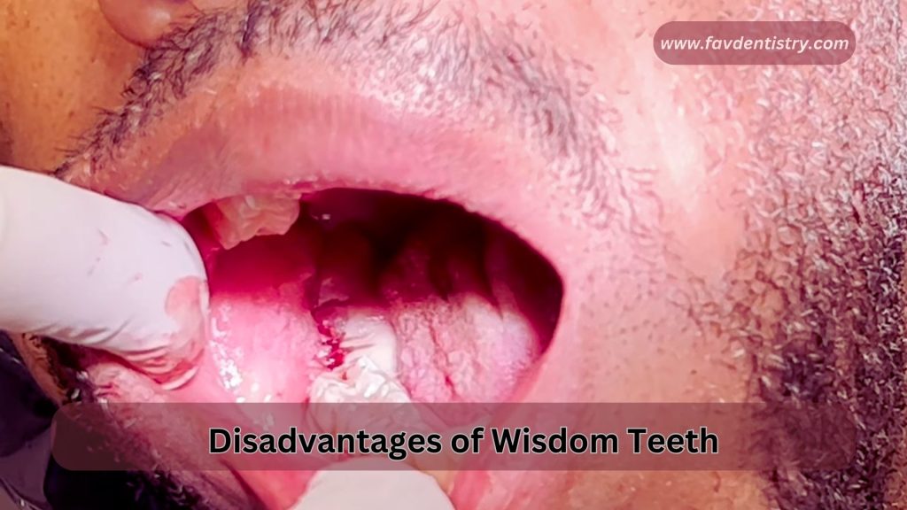 disadvantages-of-wisdom-teeth-unraveling-the-hidden-dangers