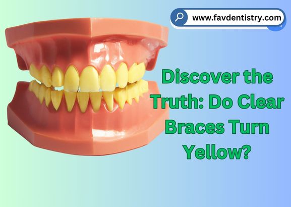 Discover the Truth: Do Clear Braces Turn Yellow?