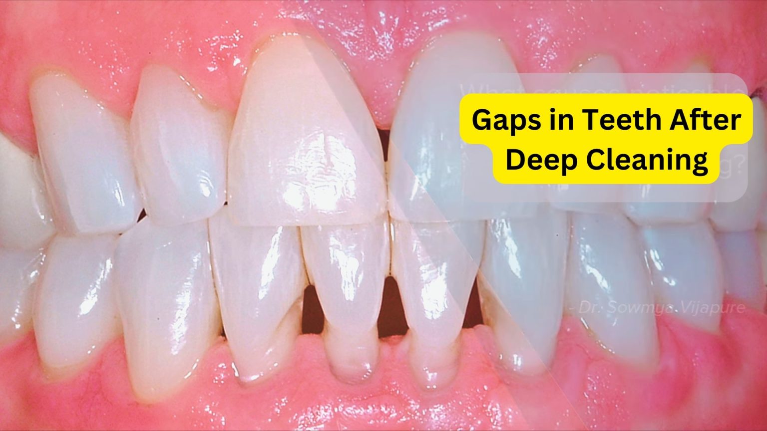 Gaps in Teeth After Deep Cleaning: Causes, Treatment, and Prevention ...