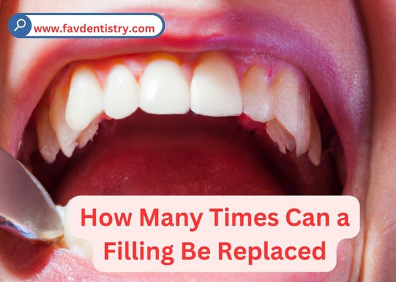 How Many Times Can a Filling Be Replaced: Unleashing the Limit