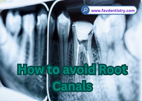 How to avoid Root Canals