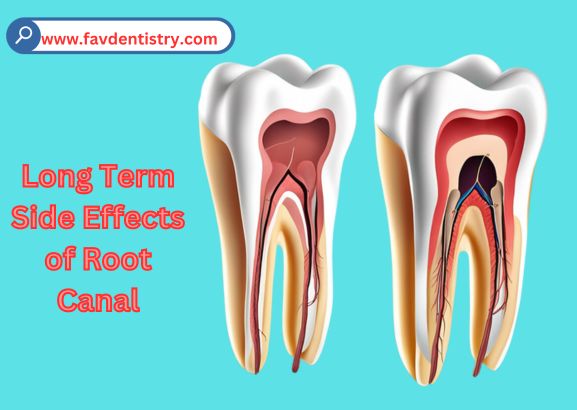 Unveiling the Hidden Dangers: Long Term Side Effects of Root Canal
