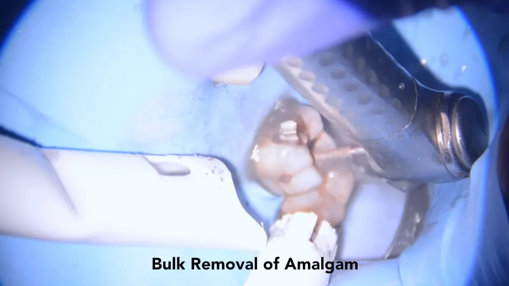 Removal of amalgam filling