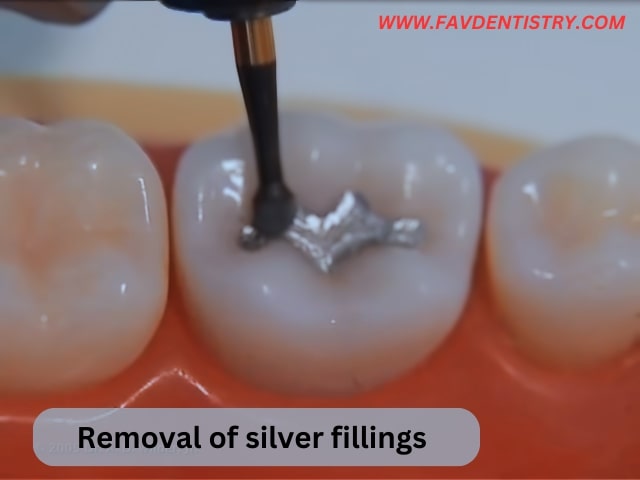 Removal of silver fillings