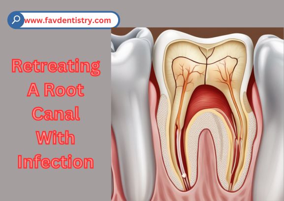 Reviving Infected Root Canals: A Step-by-Step Guide to Retreating